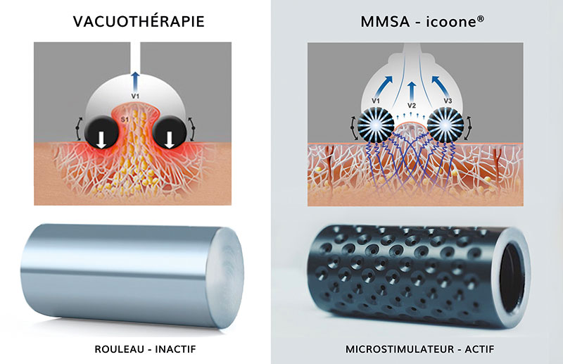 Comme l’illustre ce schéma, icoone® Beauty dépasse la vacuothérapie classique : sa technologie d’aspiration multipoints orchestre une véritable gymnastique tissulaire, respectueuse de l’architecture cutanée et du tissu conjonctif.